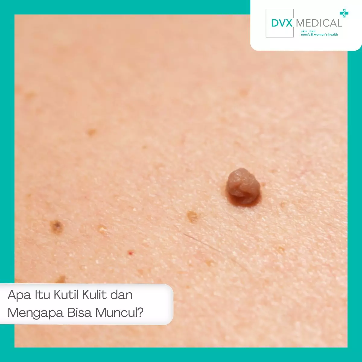 Apa Itu Kutil Kulit dan Mengapa Bisa Muncul?