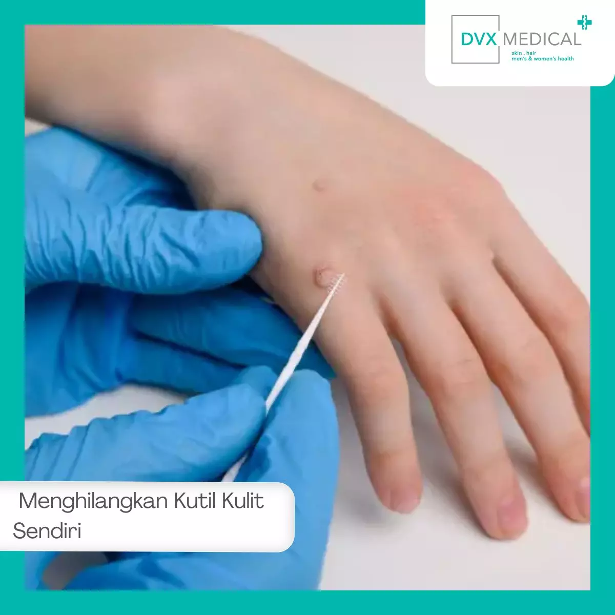 Mengapa Banyak Orang Menghilangkan Kutil Kulit Sendiri?