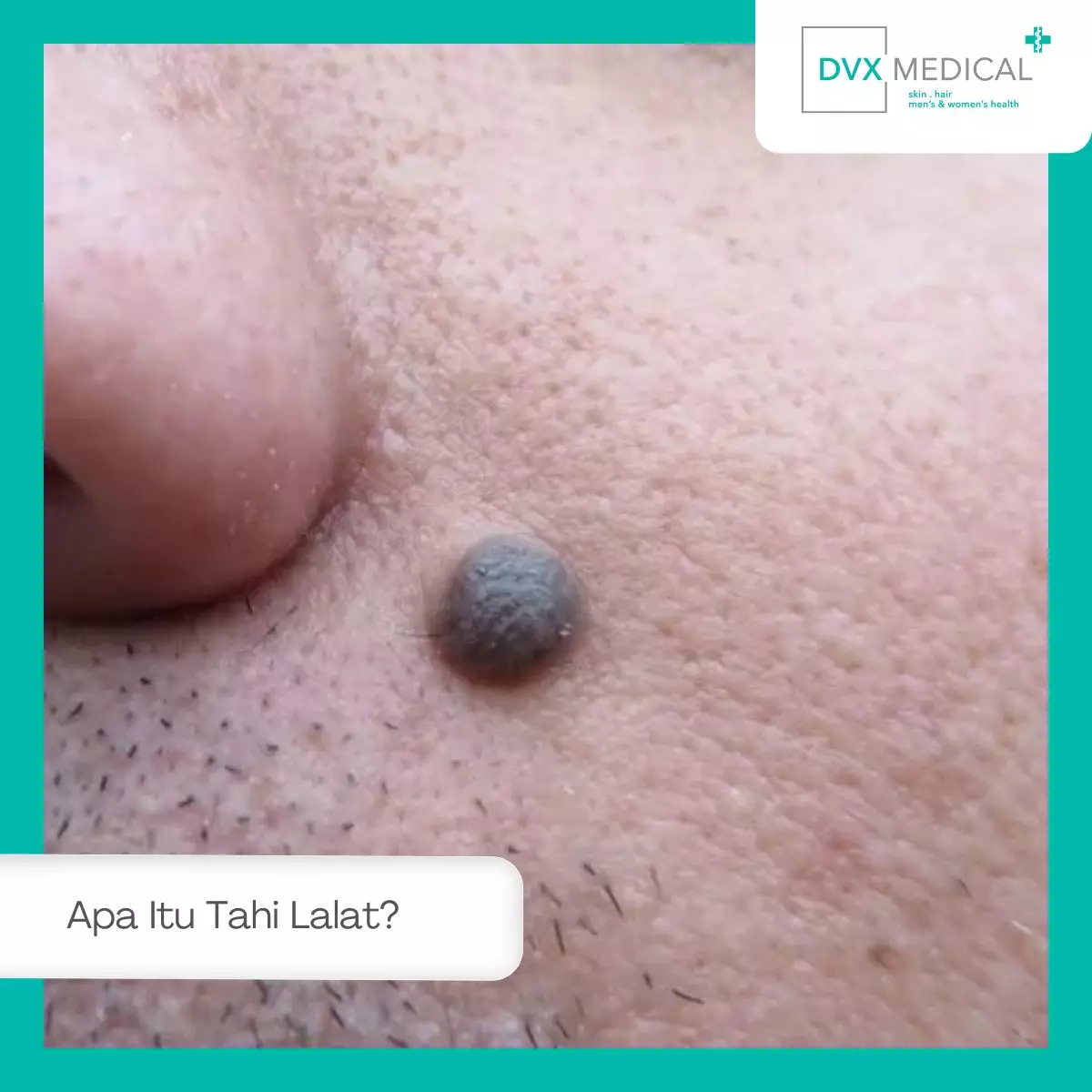 Apa Itu Tahi Lalat?
