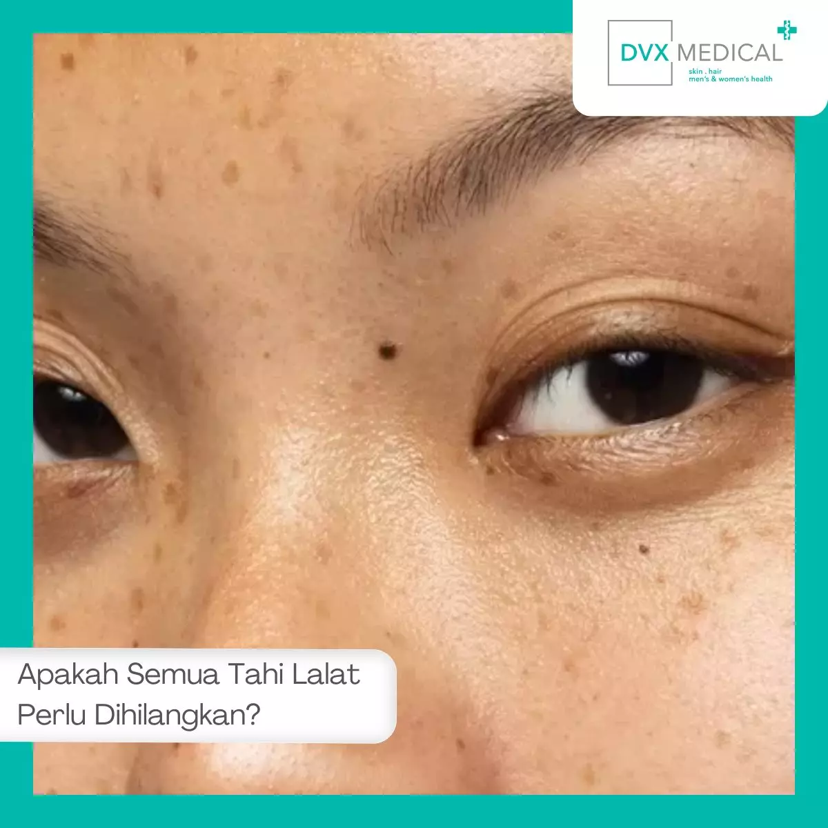 Apakah Semua Tahi Lalat Perlu Dihilangkan?