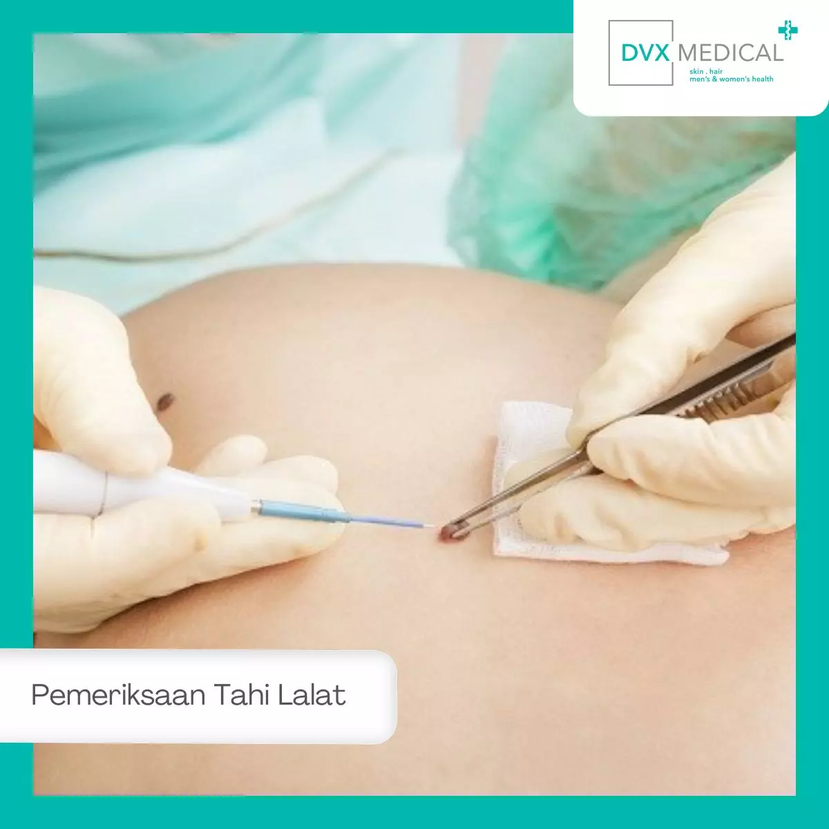Bagaimana Pemeriksaan Tahi Lalat Dilakukan oleh Dokter Kulit?