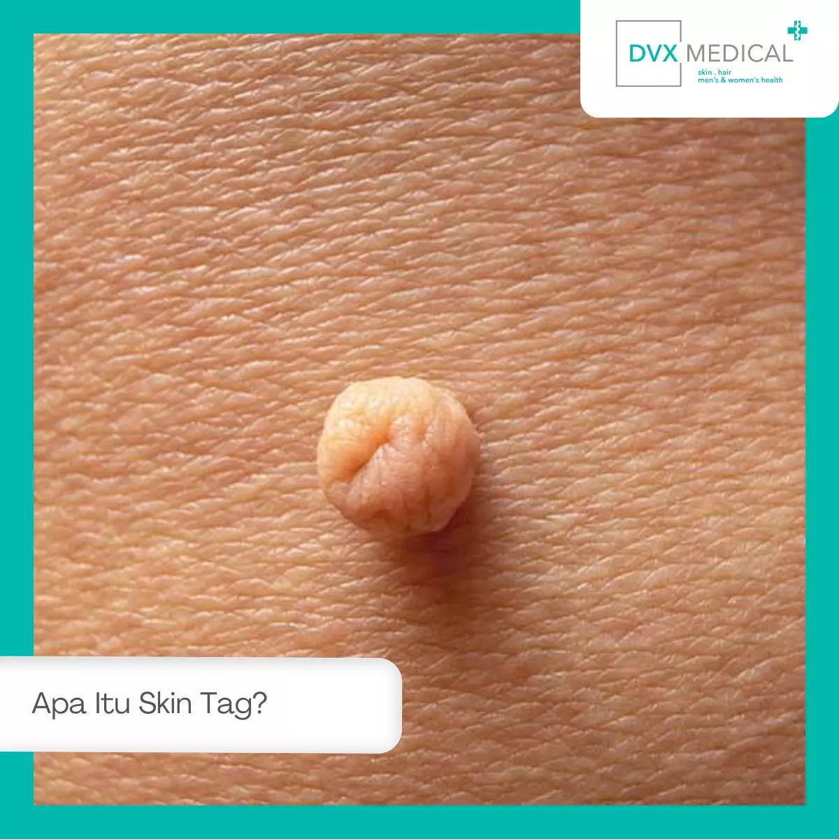Apa Itu Skin Tag?