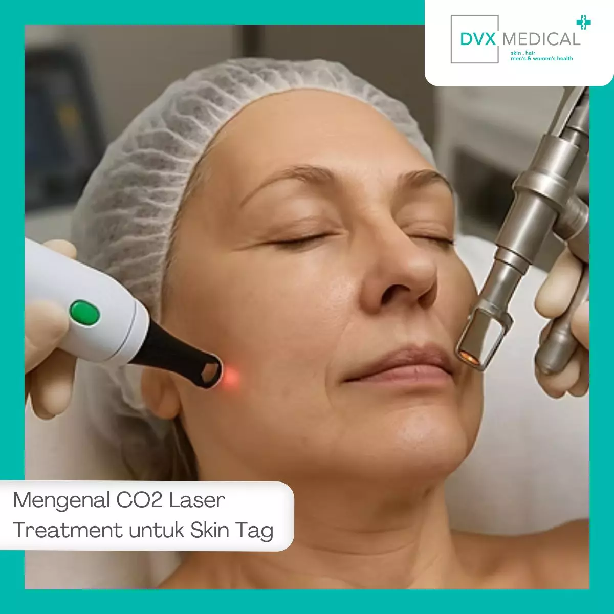 Mengenal CO2 Laser Treatment untuk Skin Tag