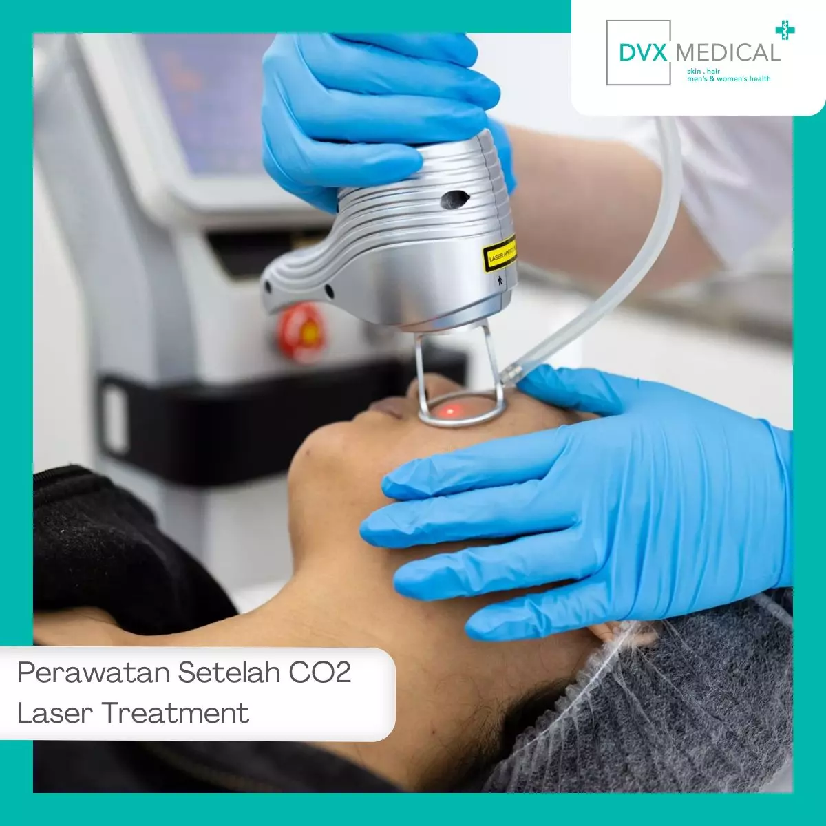 Perawatan Setelah CO2 Laser Treatment
