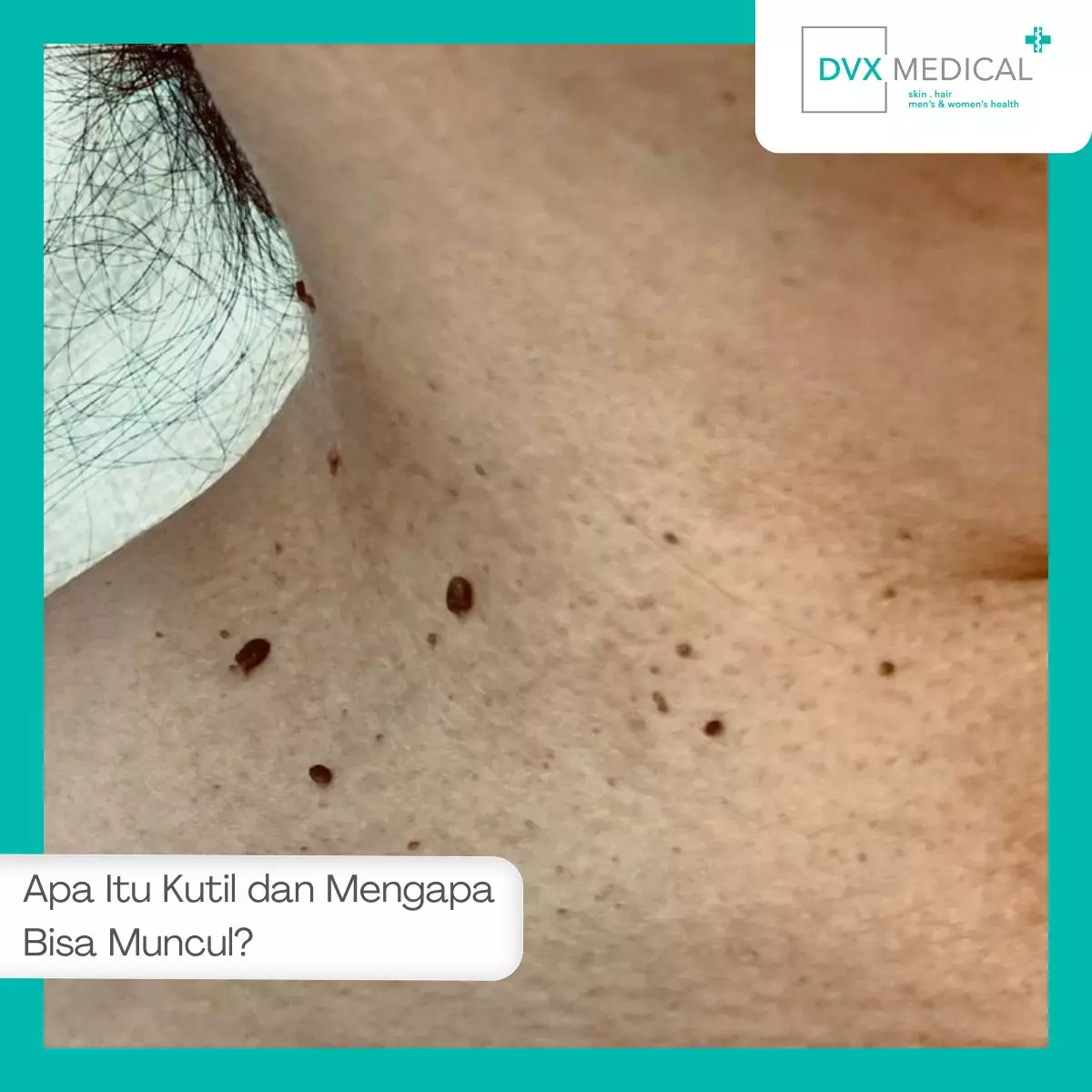 Apa Itu Kutil dan Mengapa Bisa Muncul?