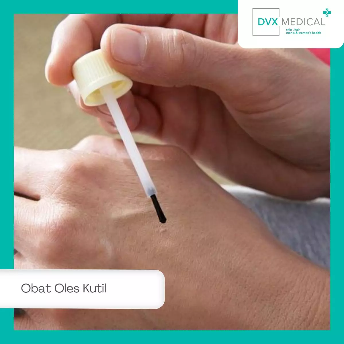 Obat Oles Kutil, Cara Kerja dan Keterbatasannya