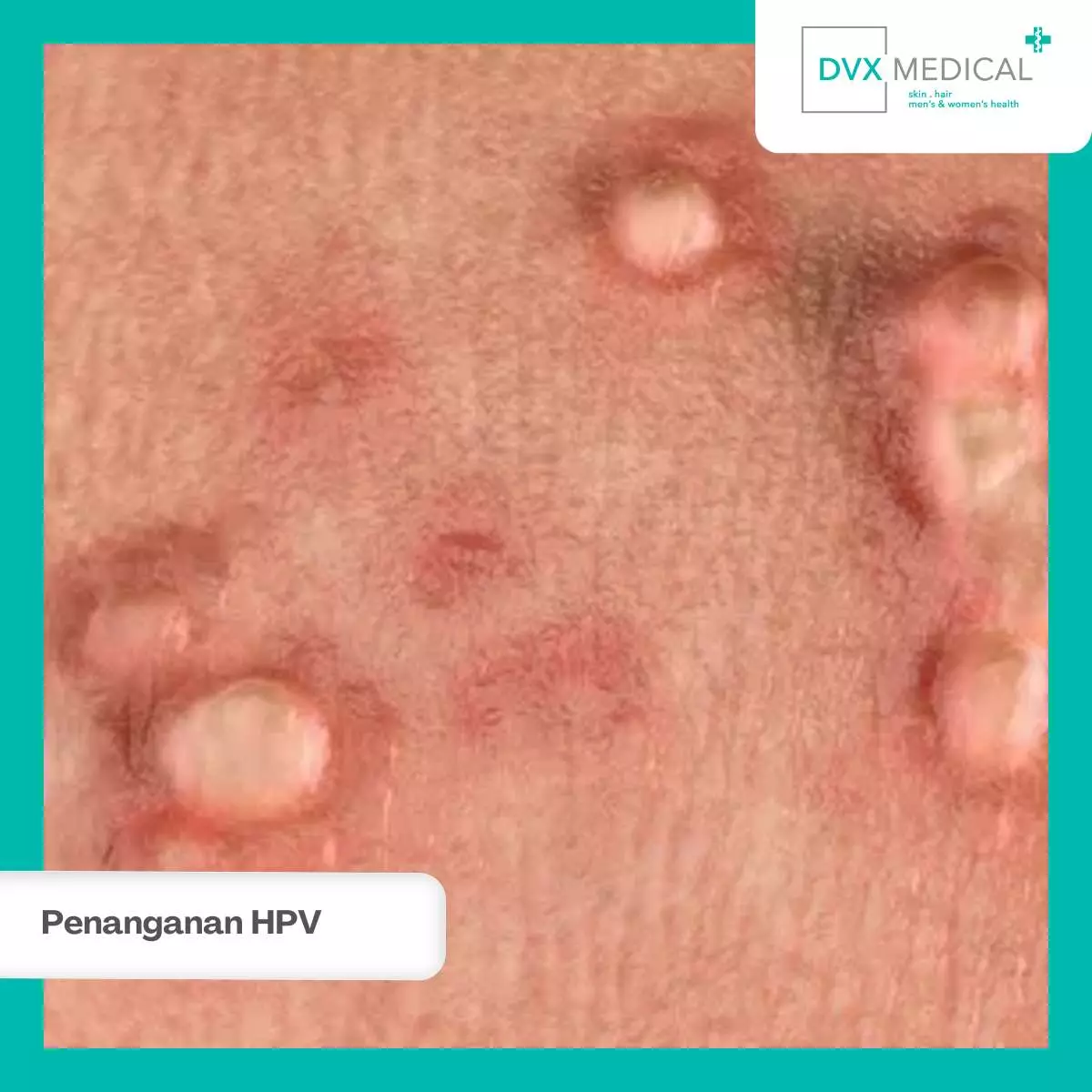 Cara Penularan HPV yang Perlu Diwaspadai