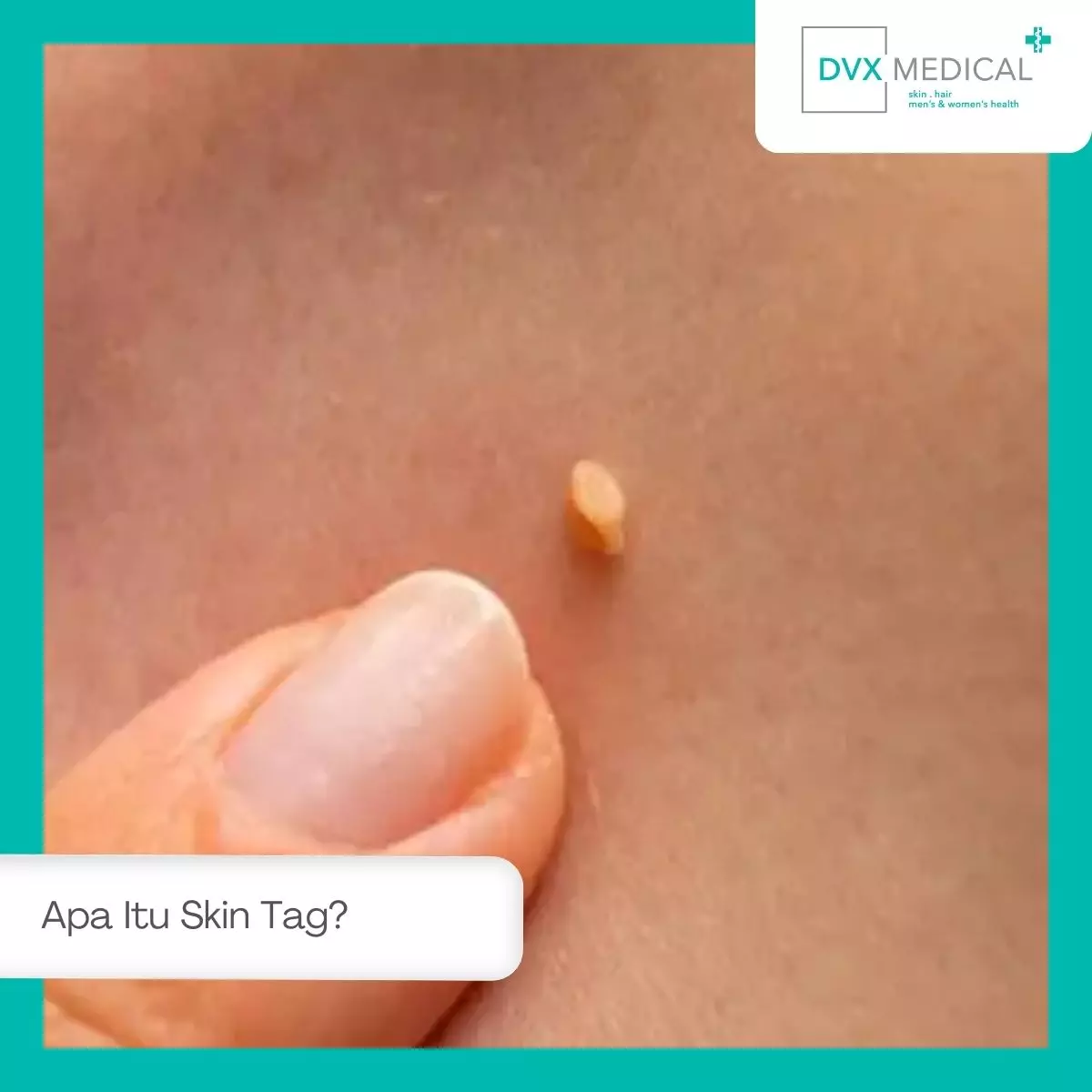 Apa Itu Skin Tag?