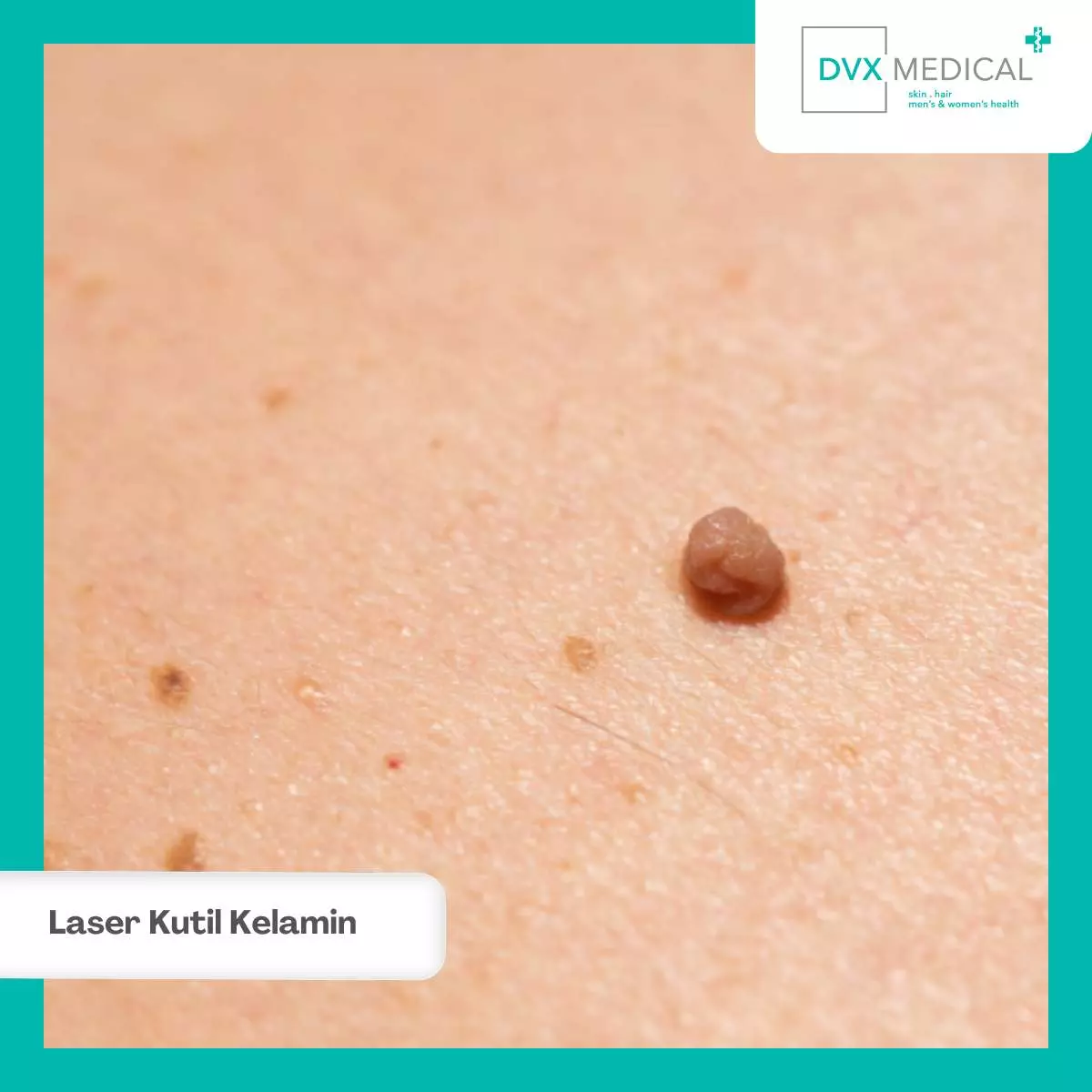 Terapi Laser Kutil Kelamin
