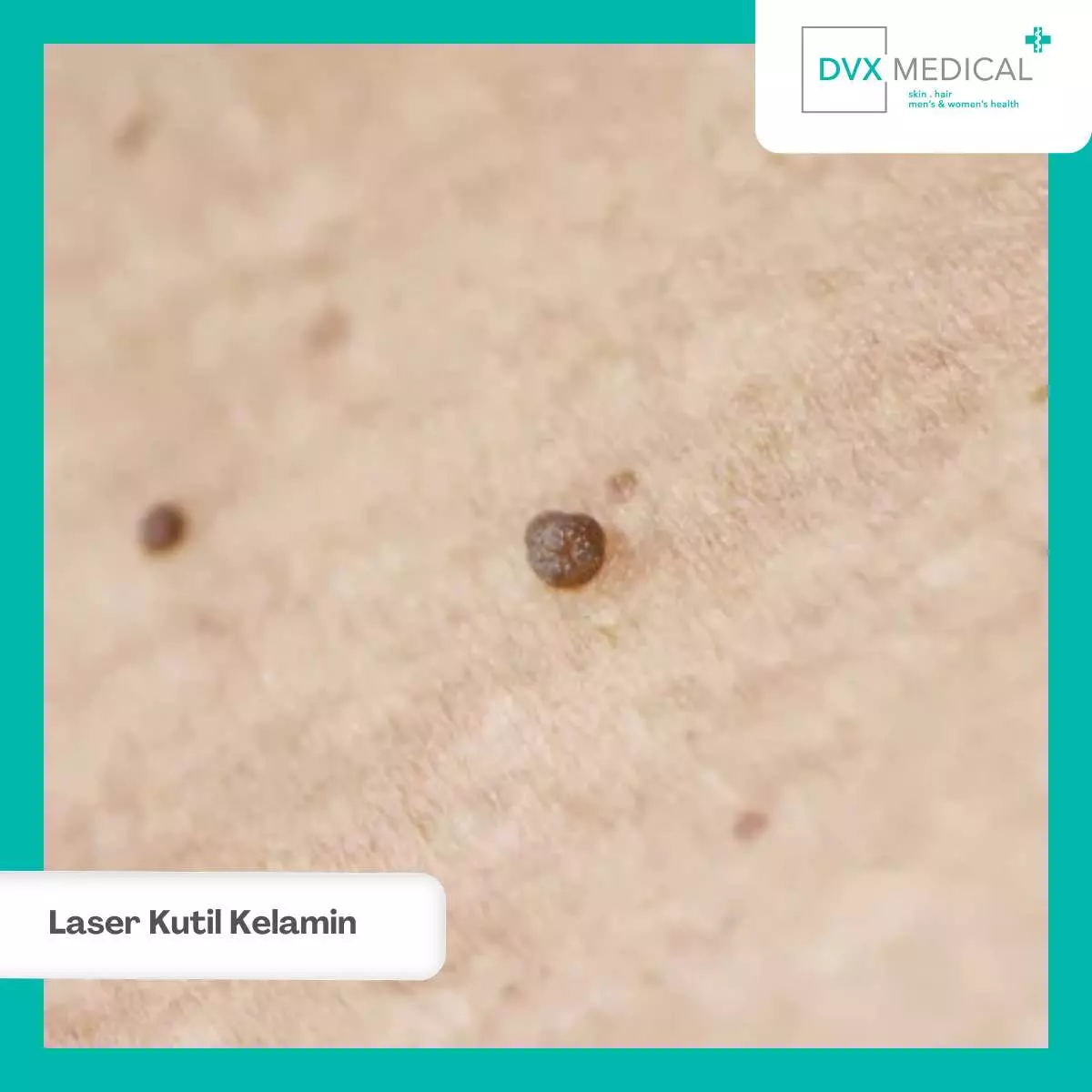 Prosedur Terapi Laser Kutil Kelamin di Klinik DVX Surabaya