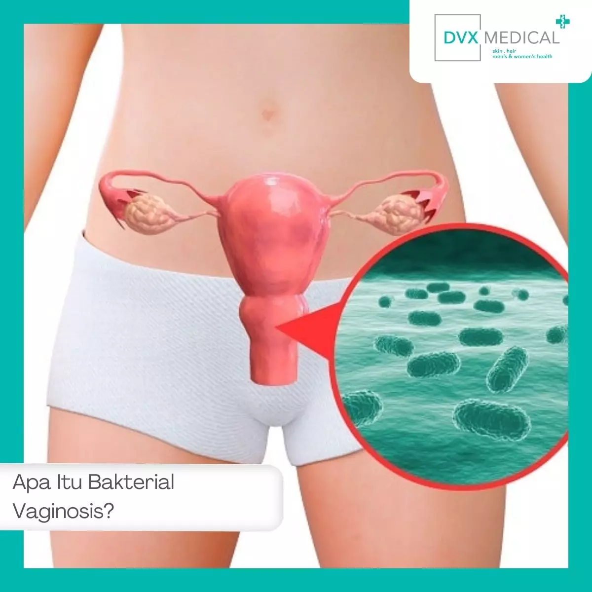 Apa Itu Bakterial Vaginosis?