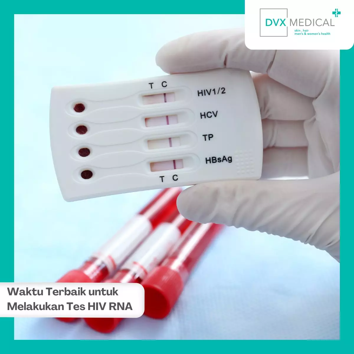Kapan Waktu yang Tepat untuk Tes HIV RNA?