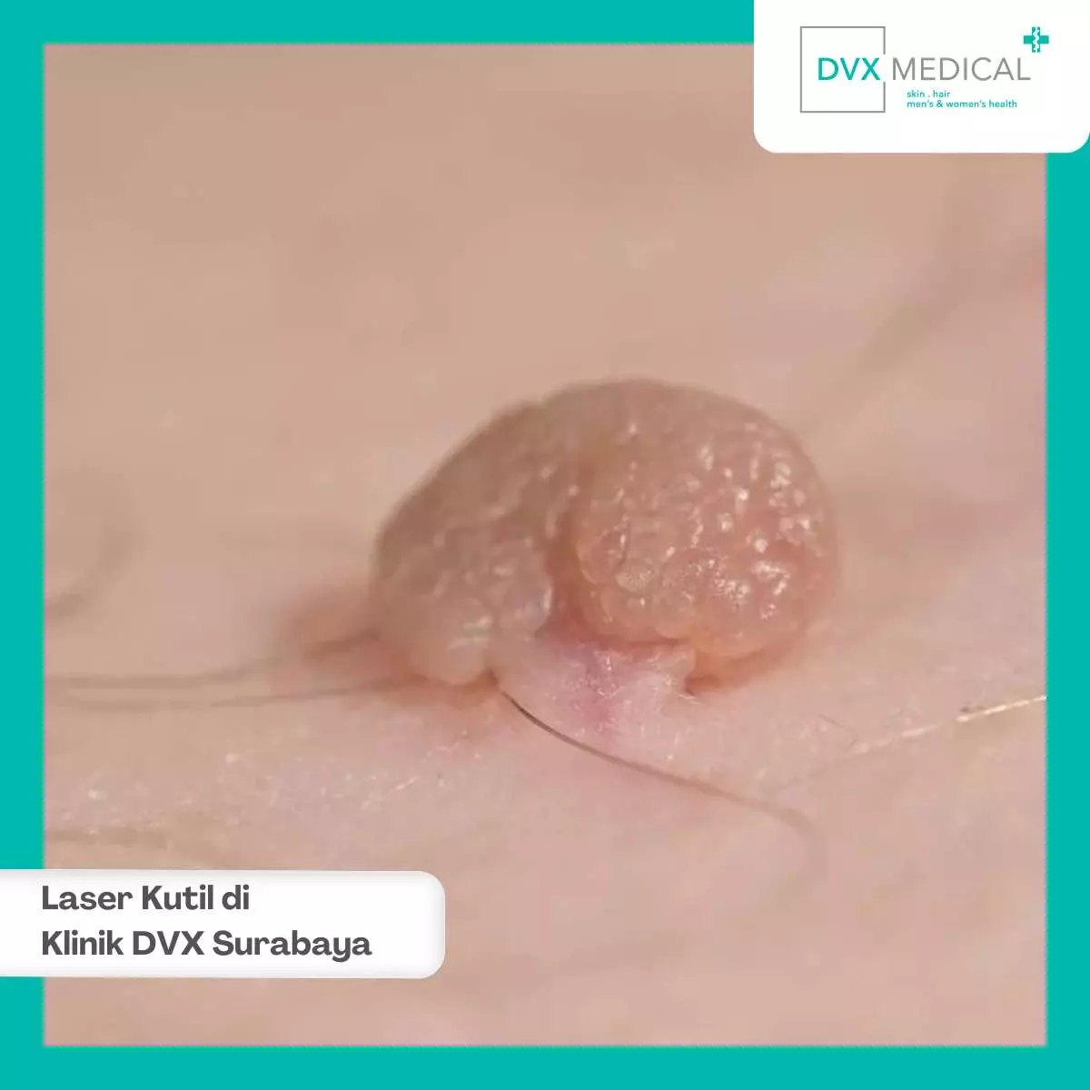 Laser Kutil Kelamin di Klinik DVX Surabaya, Solusi Medis Modern