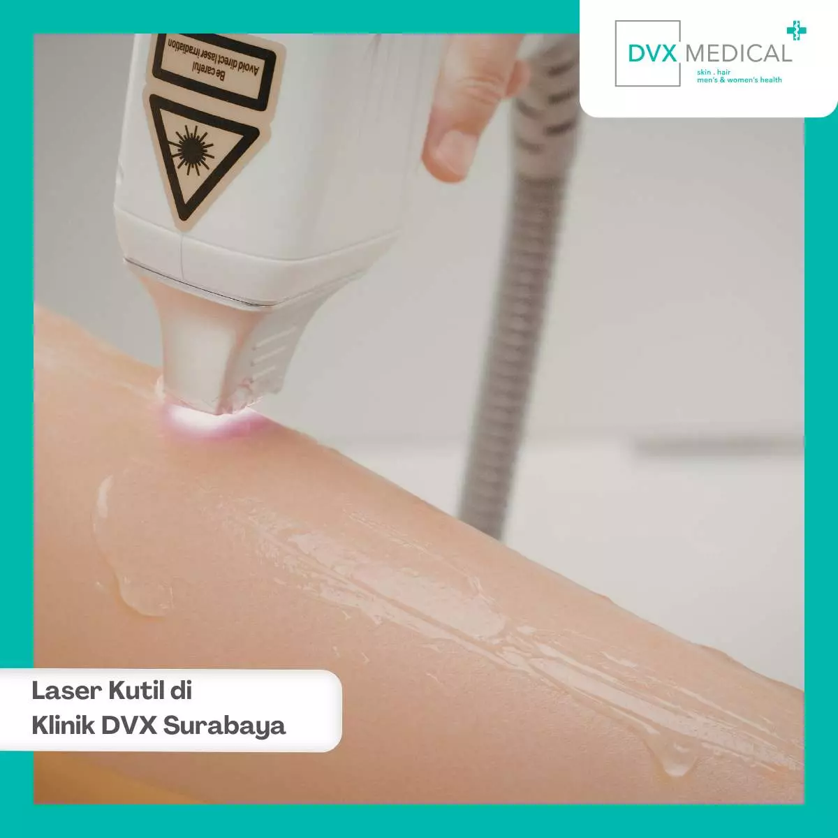 Proses Tindakan Laser Kutil di Klinik DVX Surabaya