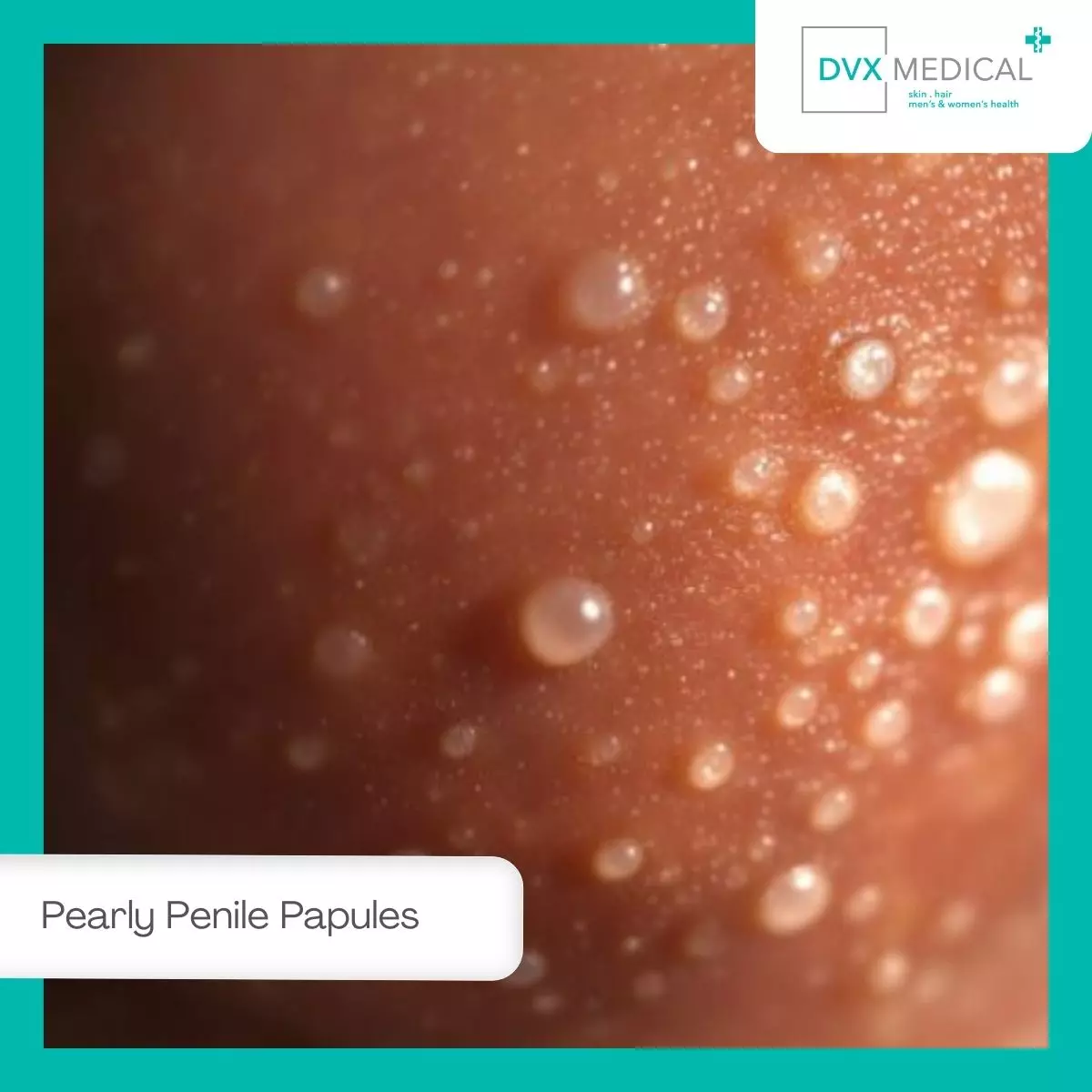 1. Pearly Penile Papules (Bintik Putih di Kepala Penis yang Normal)
