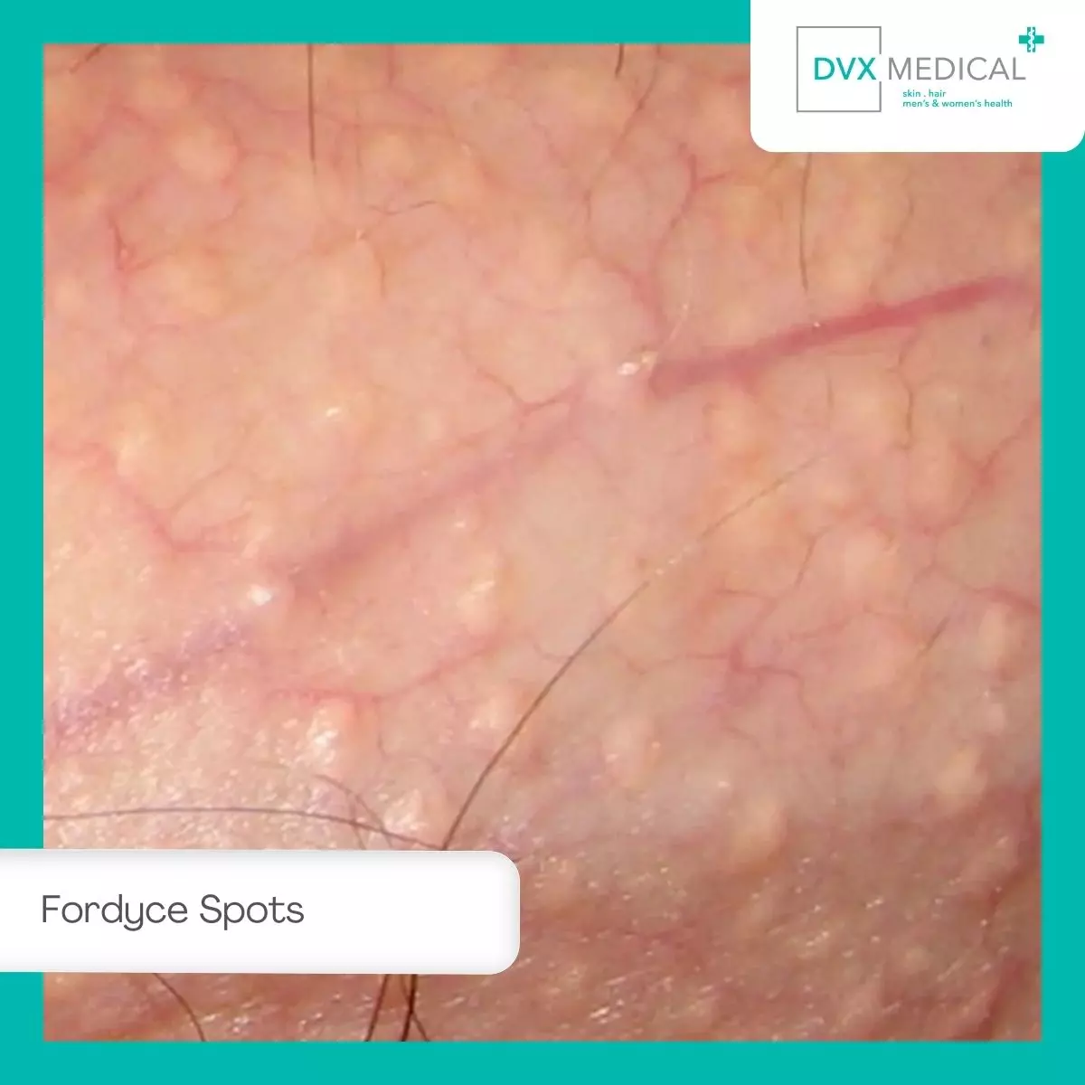 2. Fordyce Spots (Bintik Putih Kecil di Penis)
