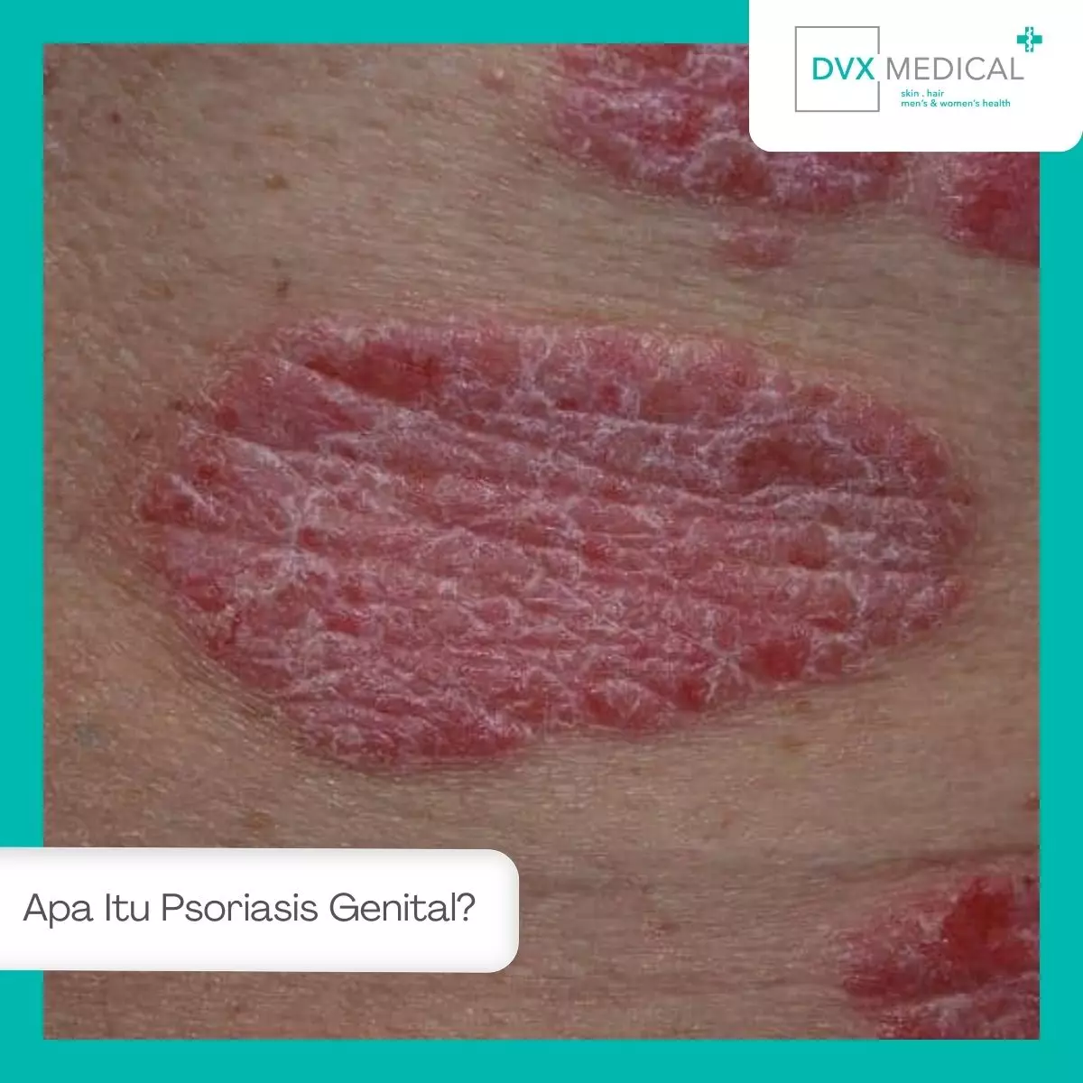 Apa Itu Psoriasis Genital?