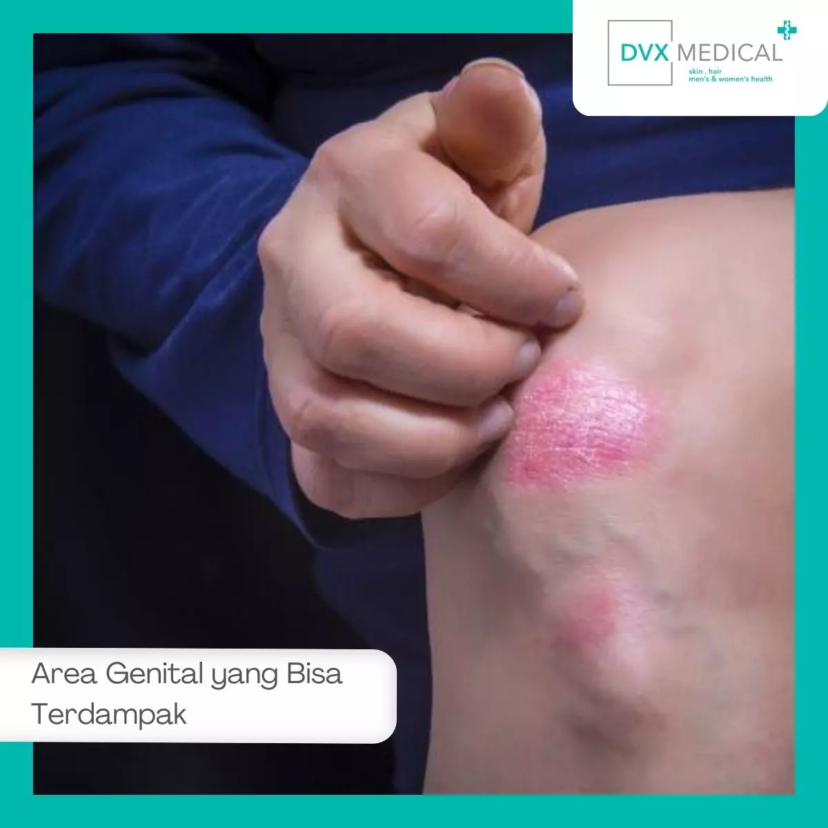 Area Genital yang Bisa Terdampak