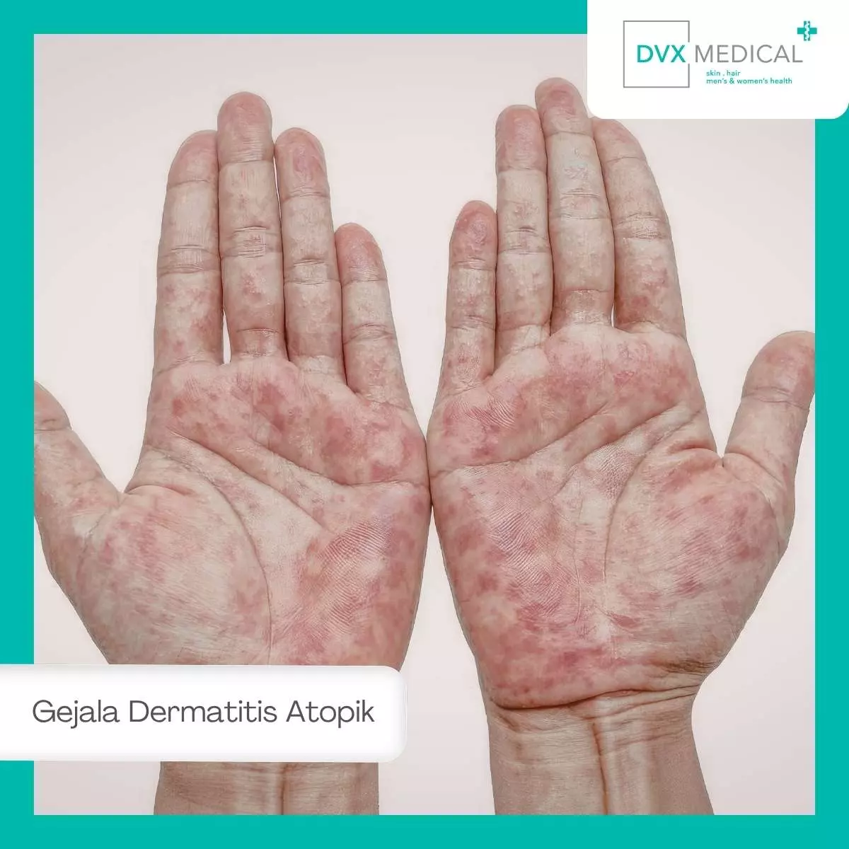 Apa Itu Dermatitis Atopik?