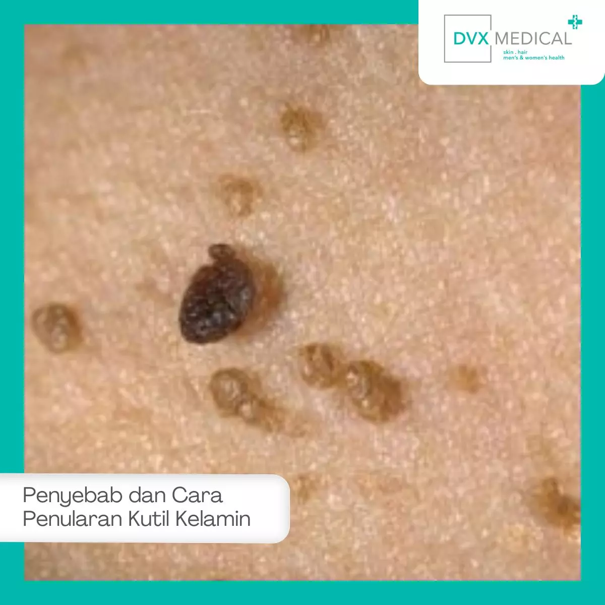 Penyebab dan Cara Penularan Kutil Kelamin