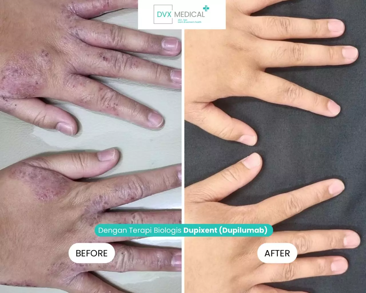 Before After Dupilumab.Jpeg