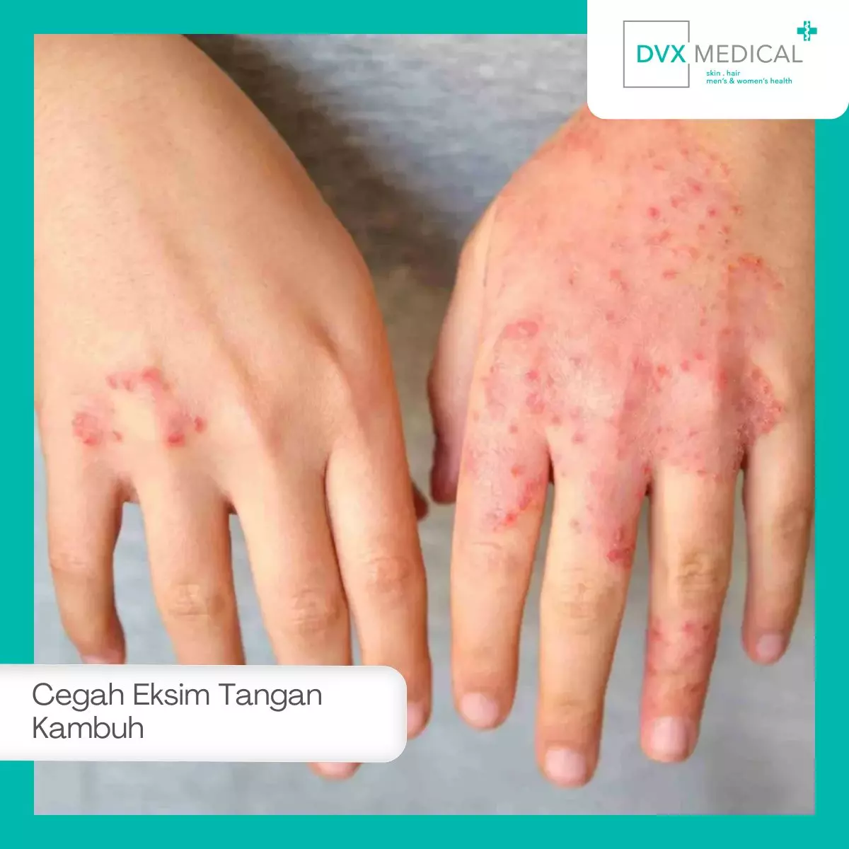 Cara Mencegah Eksim di Tangan Agar Tidak Kambuh