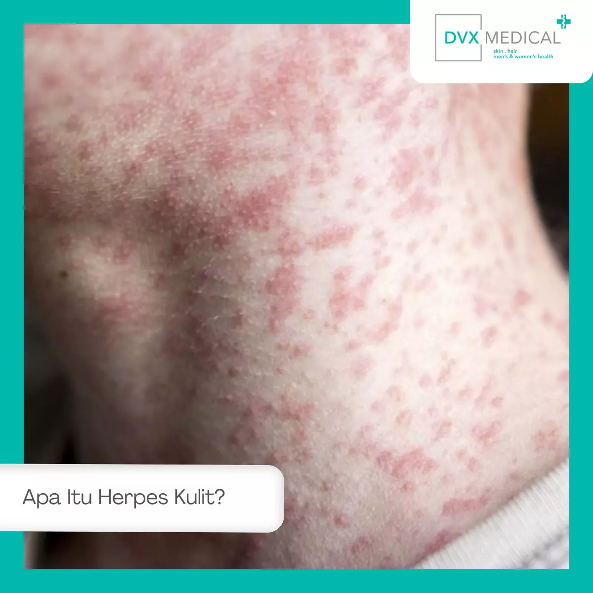 Apa Itu Herpes Kulit?