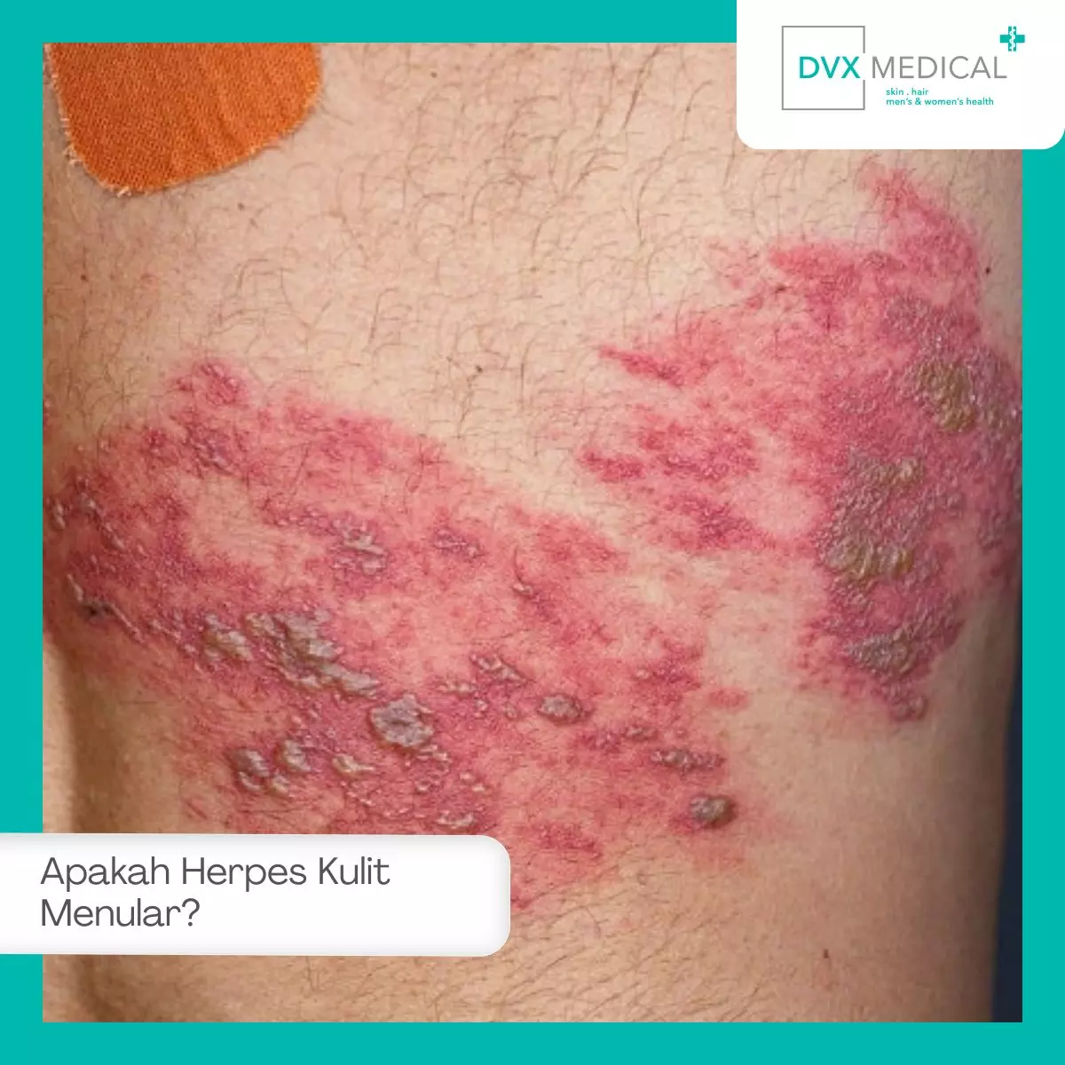 Apakah Herpes Kulit Menular?