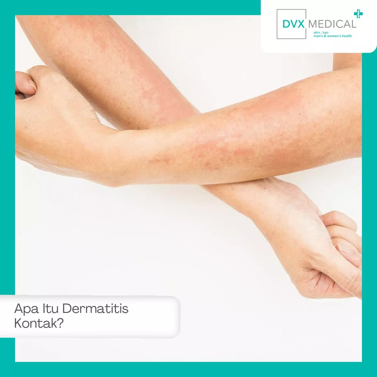 Apa Itu Dermatitis Kontak?