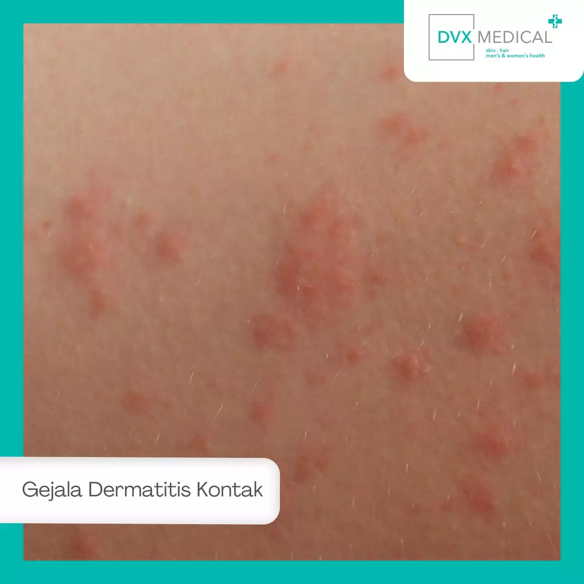 Gejala Dermatitis Kontak