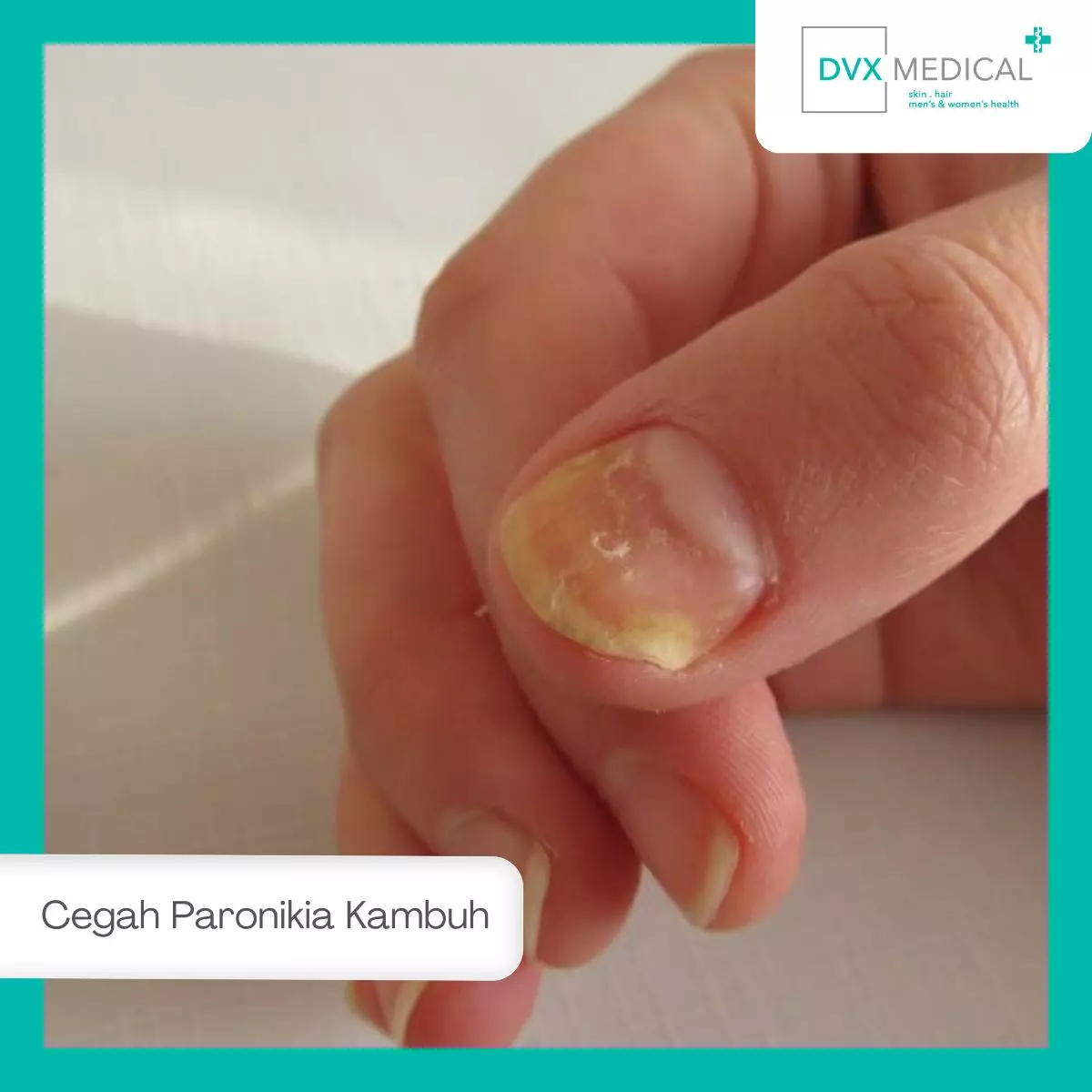 Cara Mencegah Paronikia agar Tidak Mudah Kambuh