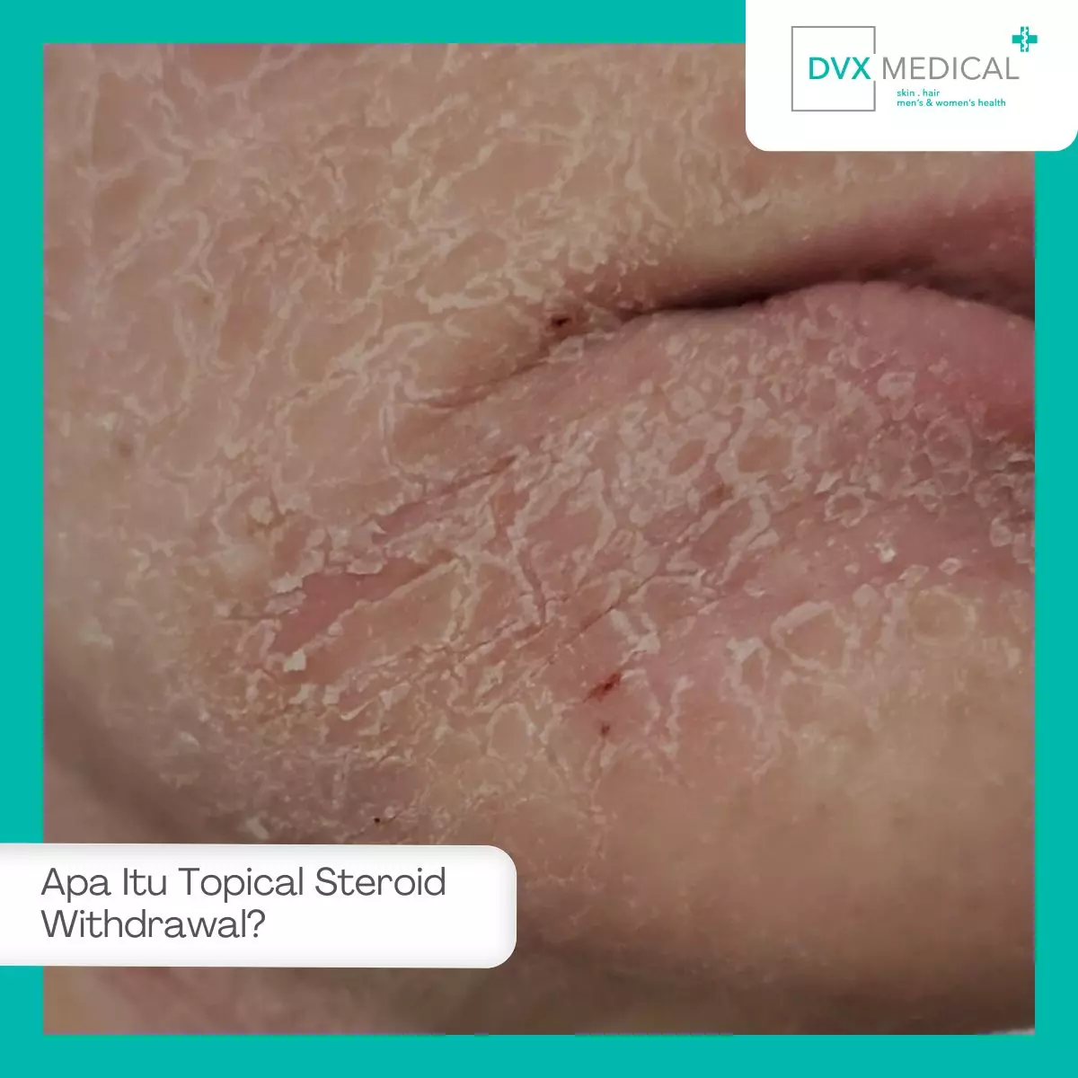 Apa Itu Topical Steroid Withdrawal?