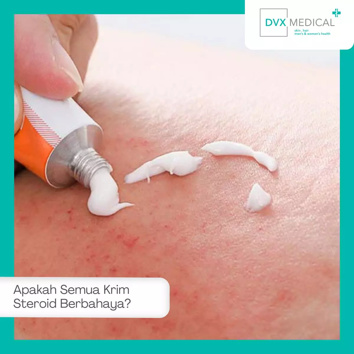 Apakah Semua Krim Steroid Berbahaya?