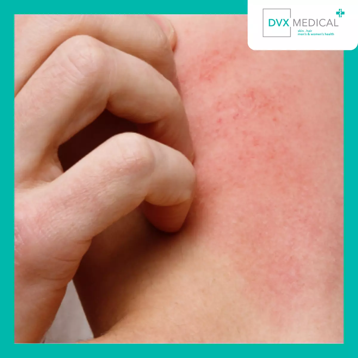 Mengapa Dermatitis Atopik Terus Meradang?