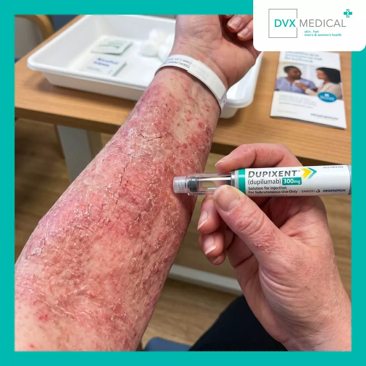Mengapa Dupilumab Menjadi Salah Satu Terapi Utama untuk Dermatitis Atopik Sedang hingga Berat?