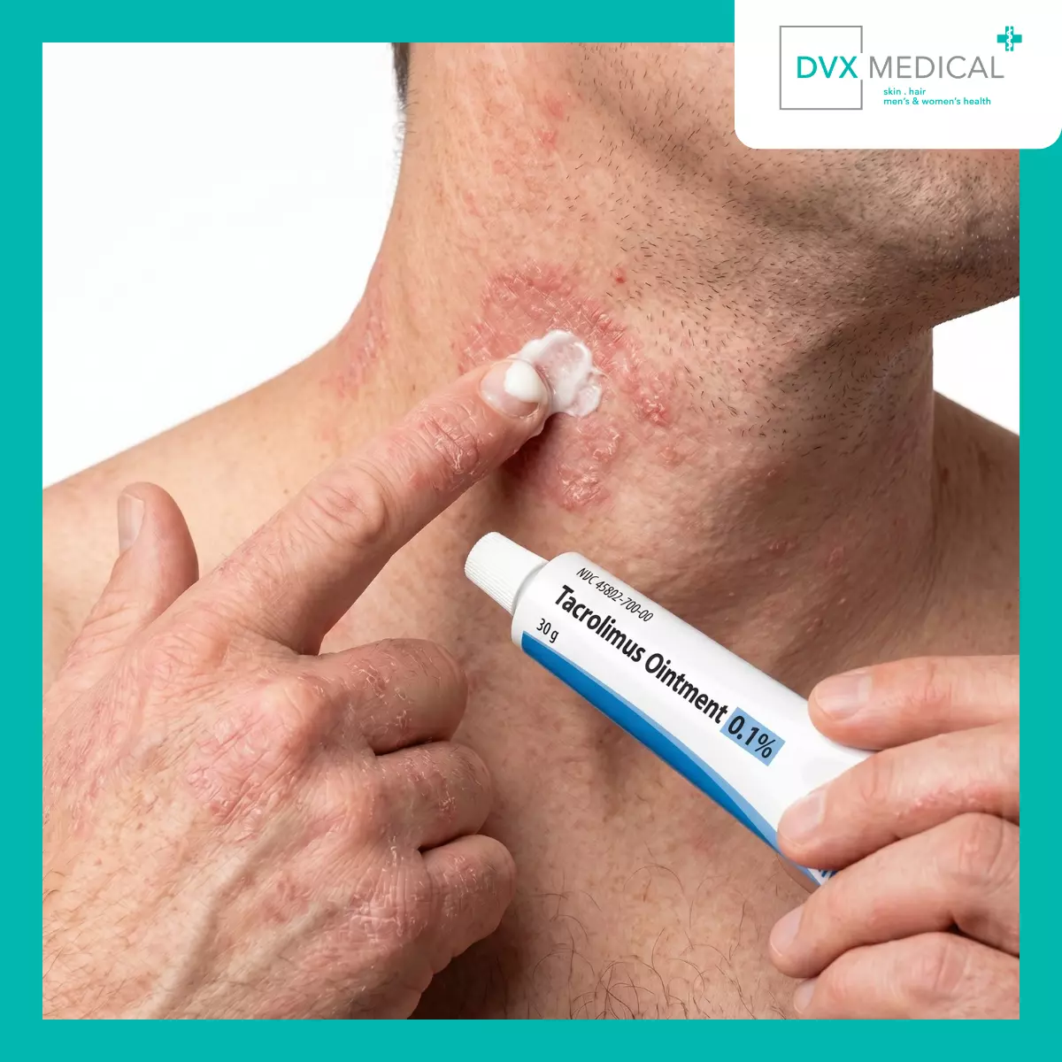 Mengapa Tacrolimus Sering Dipilih untuk Area Sensitif?