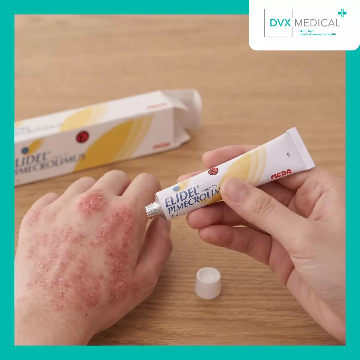 Kapan Pimekrolimus Digunakan untuk Dermatitis Atopik?
