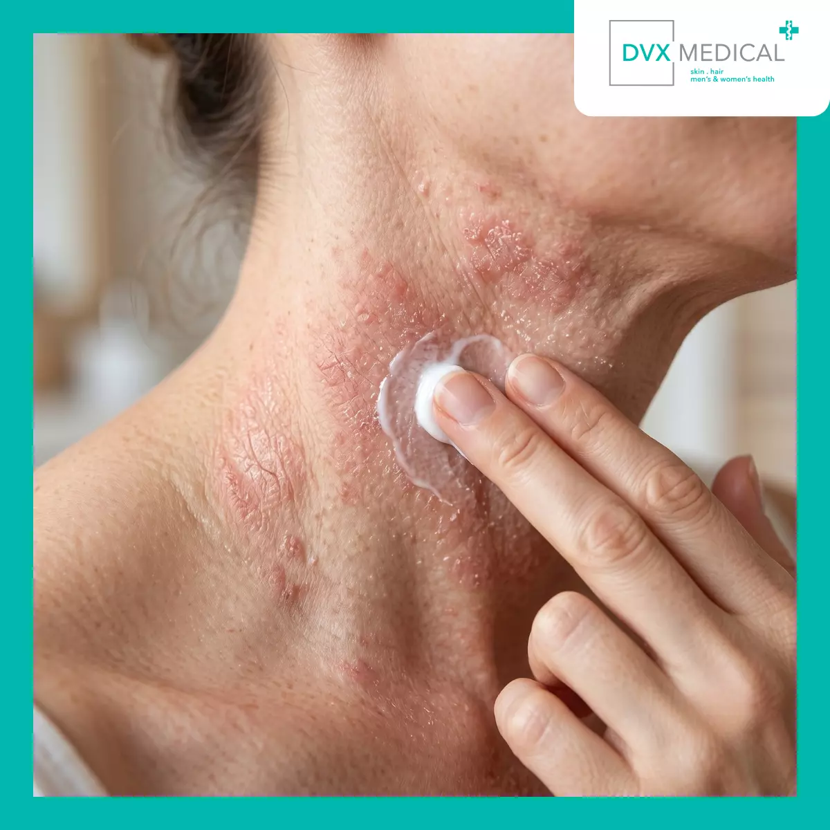 Mengapa Pimekrolimus Sering Dipilih untuk Area Sangat Sensitif?