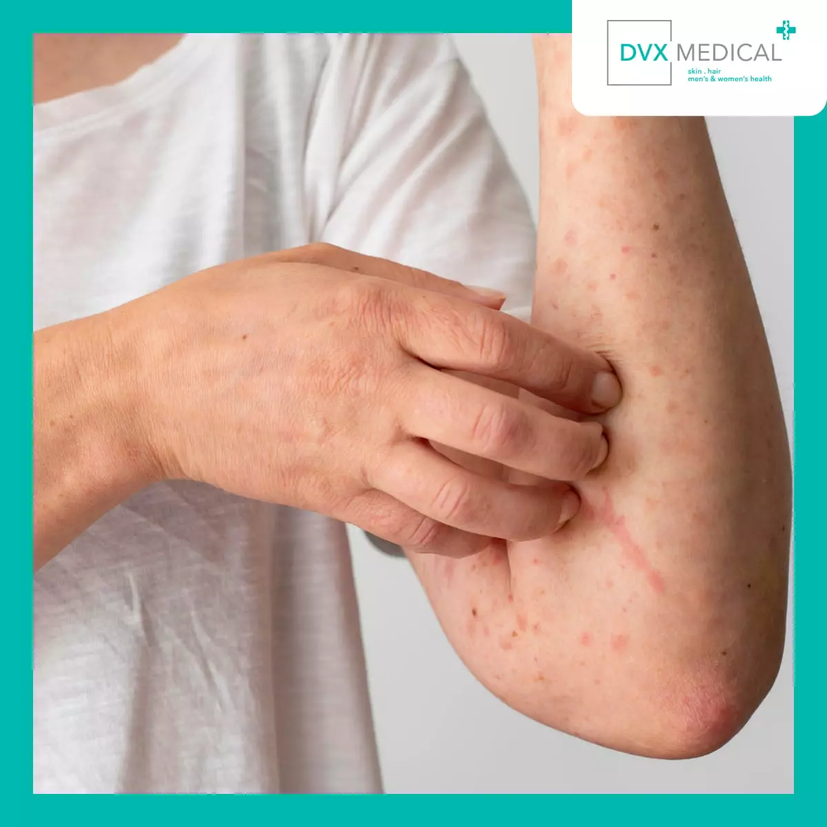 Apa yang Terjadi pada Kulit Dermatitis Atopik?