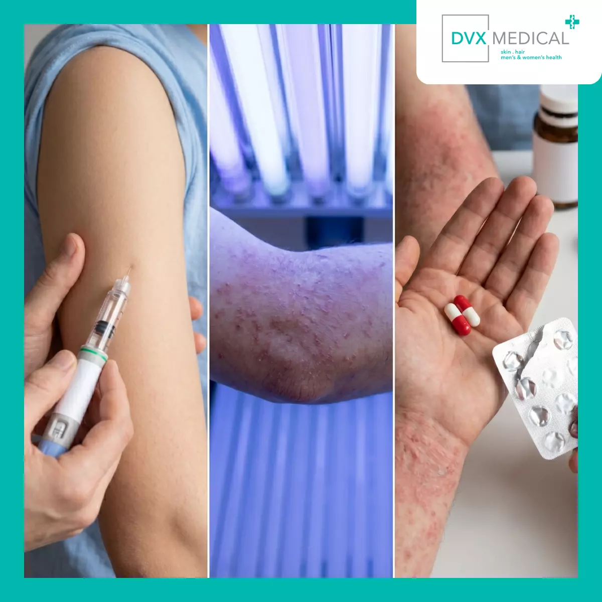 Kapan Excimer Dipertimbangkan dalam Alur Terapi Dermatitis Atopik?