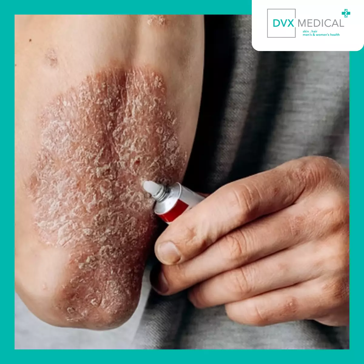 Apakah Saya Harus Berhenti Menggunakan Krim Steroid?