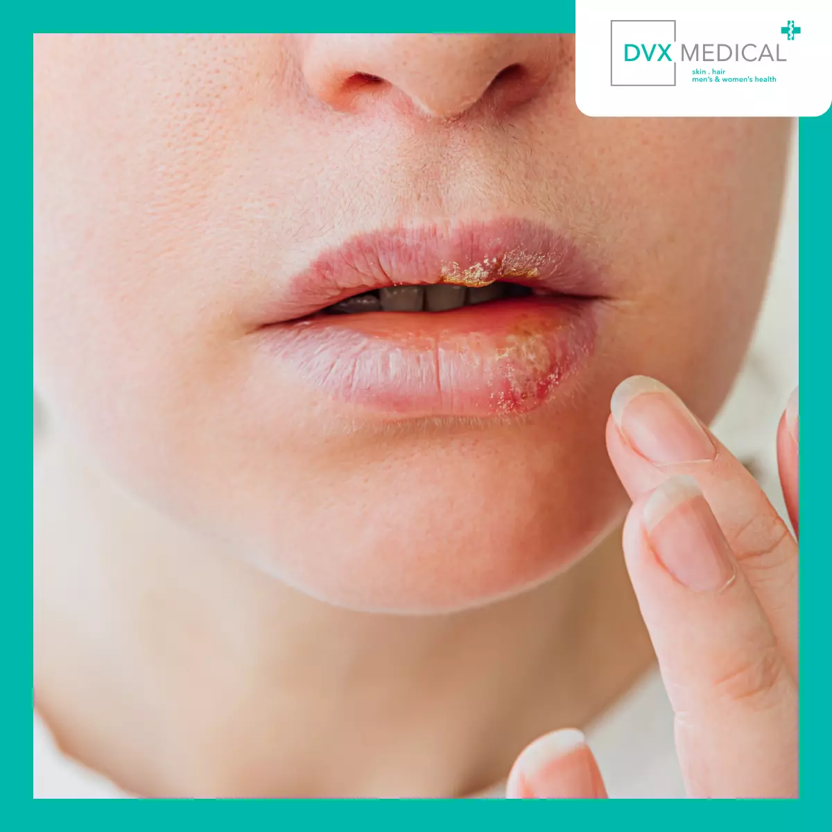 Cheilitis Atopik atau Cheilitis Kontak? Cara Membedakannya
