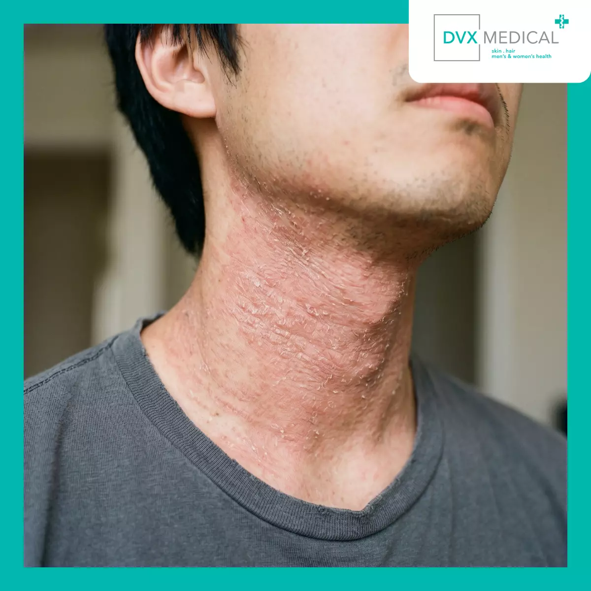 Apa yang Dimaksud dengan Topical Steroid Withdrawal?