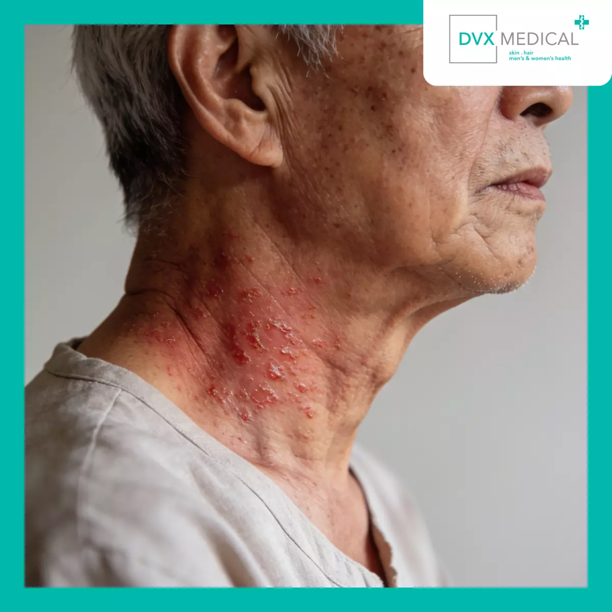 Apakah Dermatitis Atopik Selalu Menetap Seumur Hidup?