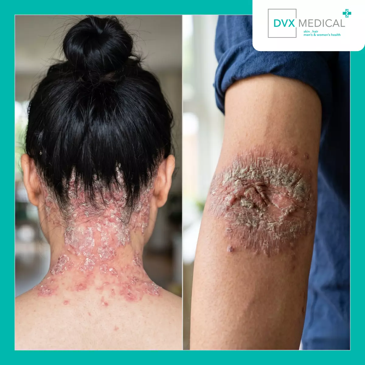 Mengapa Dua Pasien dengan Psoriasis yang Mirip Bisa Mendapatkan Biologik yang Berbeda?