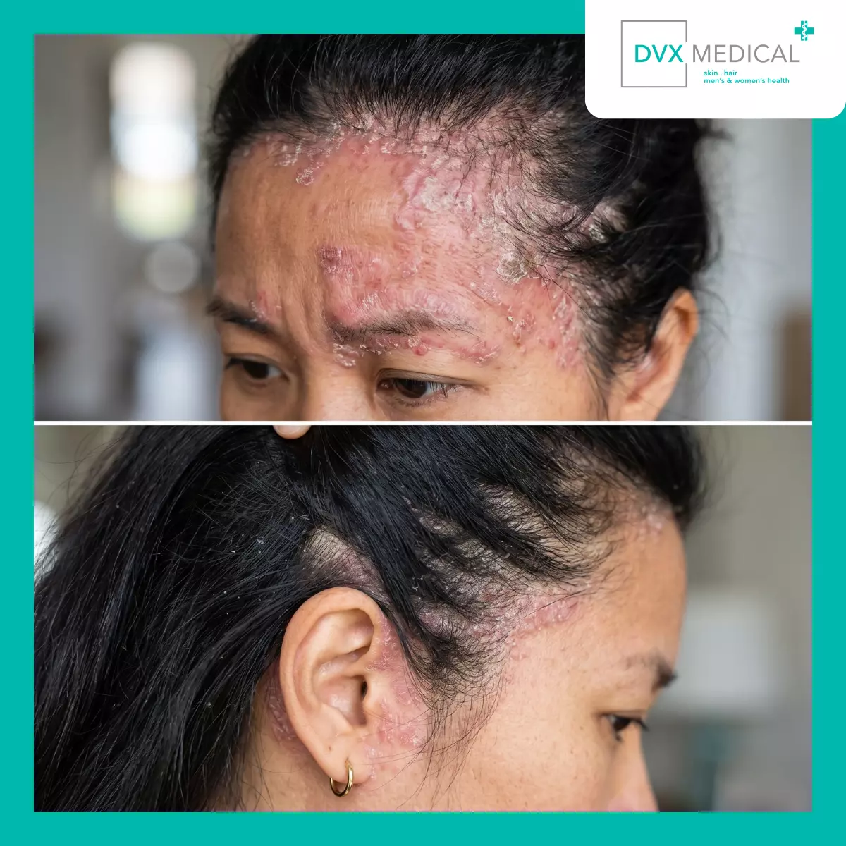 Mengapa Tidak Semua Psoriasis Memerlukan Tingkat Penanganan yang Sama?