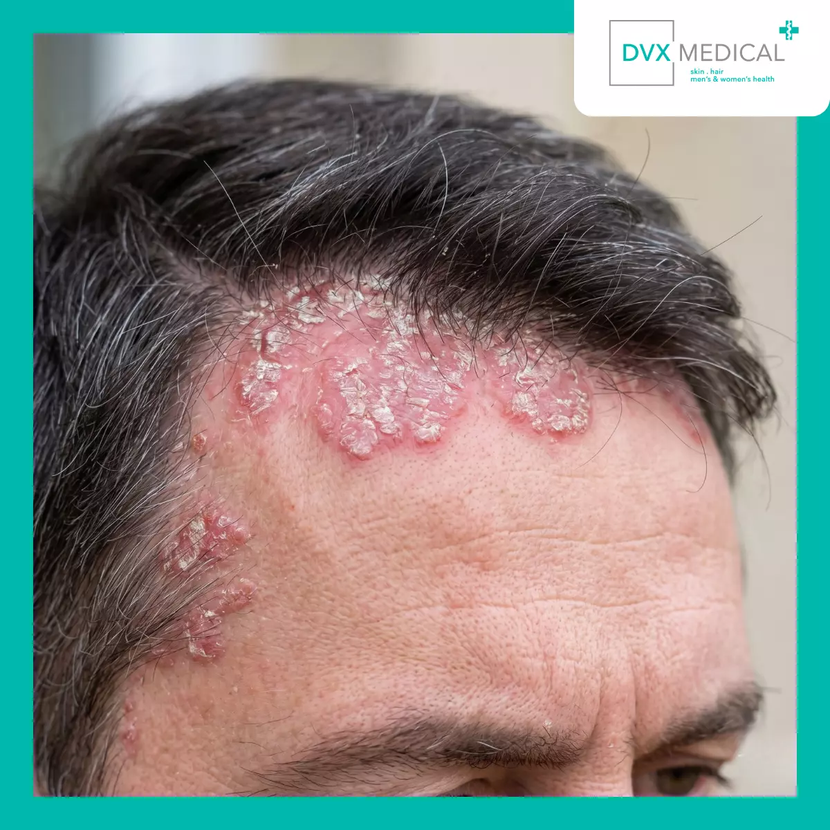 Mengapa Psoriasis Sering Terlihat Lebih Sederhana daripada Kenyataannya?