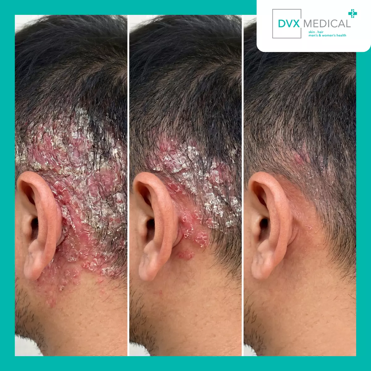 Apakah Harus Menunggu Sampai Psoriasis Menjadi Berat?