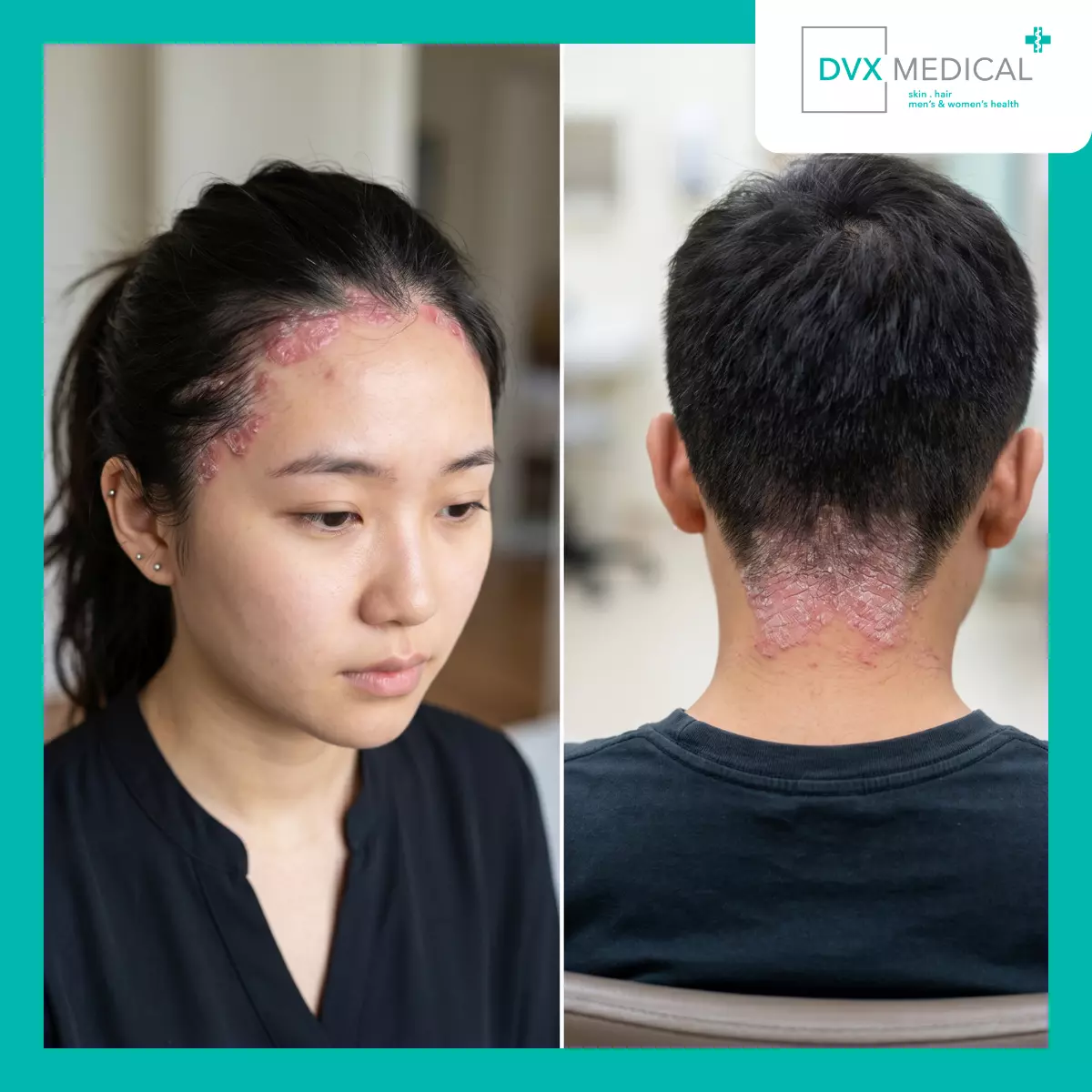 Mengapa Dua Pasien dengan Psoriasis yang Mirip Bisa Memiliki Prioritas yang Berbeda?
