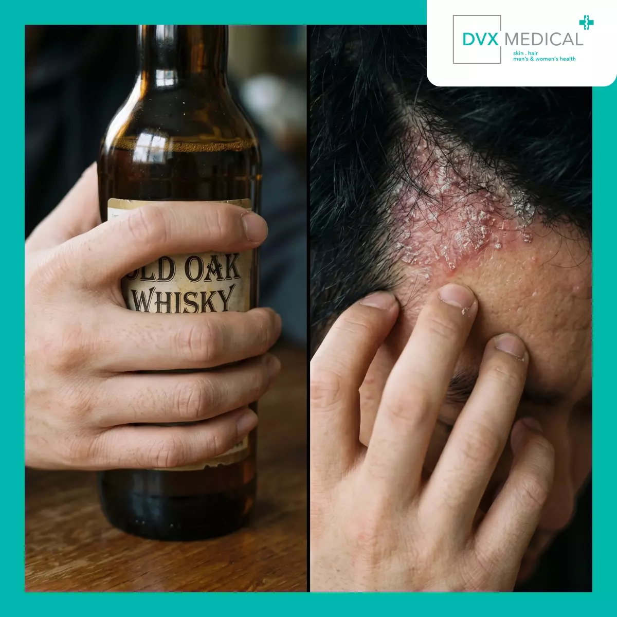 Mengapa Hubungan antara Alkohol dan Psoriasis Tidak Selalu Sederhana?